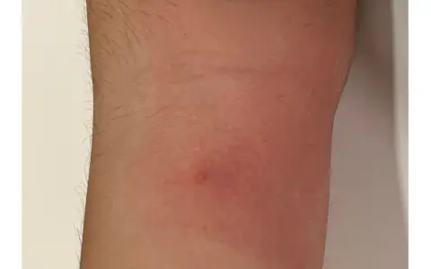 Piel enrojecida con una pequeña protuberancia, indicativa de picaduras chinches de cama como eliminarlas.