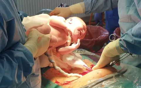 Noworodek wychodzi z brzucha mamy, ręce lekarzy pomagają w porodzie, który był w położeniu miednicowym.