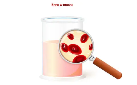 Szklanka z płynem i szkło powiększające ukazujące czerwone krwinki. Obrazek ilustruje bezbolesny krwiomocz.