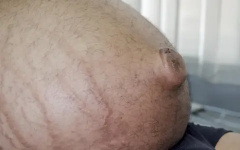 Duży brzuch z widocznymi rozstępami i przepukliną pępkową.