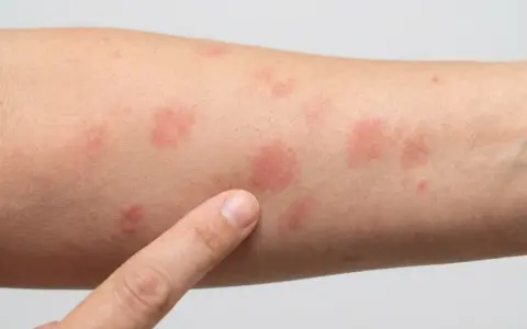 Nahaufnahme eines Arms mit mehreren roten Stellen auf der Haut, die auf einen Ausschlag oder eine allergische Reaktion hindeuten.