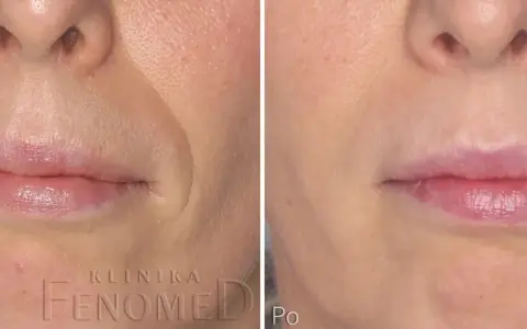 1 ml kwasu hialuronowego: Co naprawdę zmieni w Twojej twarzy?