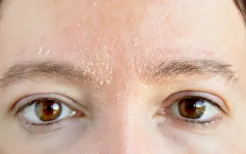 Trockene Gesichtshaut bei Männern: Ursachen, Symptome und Pflege Tipps