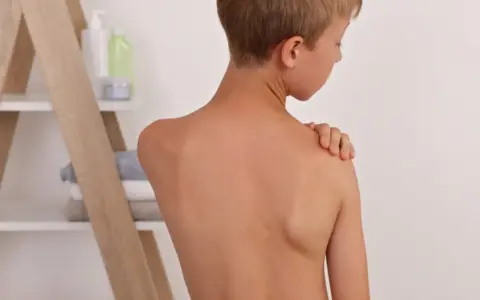 Chłopiec z nierównymi łopatkami, jedna z nich jest wyraźnie wyżej.