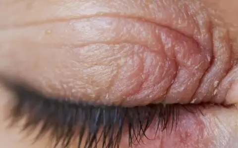 Gros plan sur un œil fermé, montrant la peau irritée et squameuse typique de l'eczéma paupière.