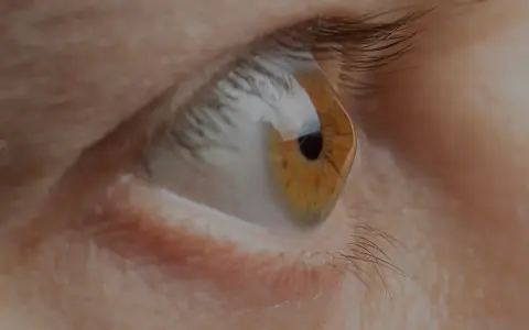 Occhio con iride ambrata e pupilla nera. La cornea deformata riflette la luce, creando un effetto visivo particolare.