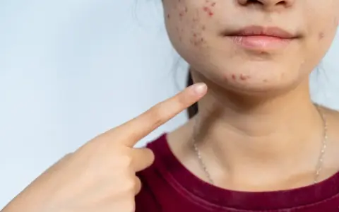 Pryszcze na brodzie od czego? Odkryj przyczyny i skuteczne rozwiązania