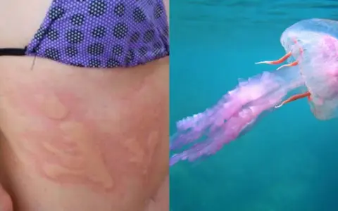 Pelle arrossata con segni di una **piqûre meduse** e una medusa rosa trasparente che nuota nell'acqua blu.