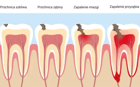 Co wziąć na ból zęba? Skuteczne leki i domowe sposoby na ulgę