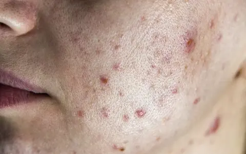 Primo piano della pelle con acne, inclusi diversi brufoli cistici e rossori.