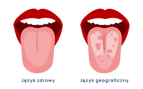 Dwa języki: zdrowy, różowy i gładki, oraz język geograficzny z plamami.