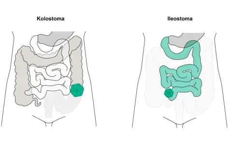 Vergleich von Kolostoma und Ileostoma: zwei stoma arten, die den Darm betreffen.