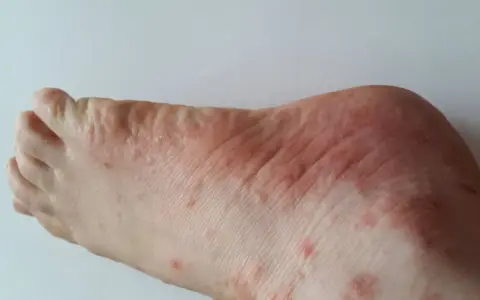 Pieds présentant des rougeurs et des petits boutons qui grattent, signe d'une irritation cutanée.