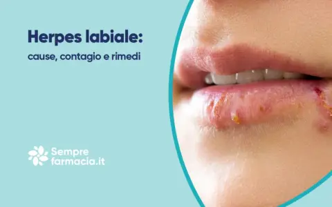 Herpes labiale: cause, contagio e rimedi. Scopri come curare l'herpes labiale e alleviare i sintomi.