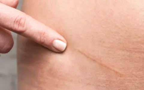 Dito indica una cicatrice da taglio, un segno che si può eliminare per una pelle più liscia.