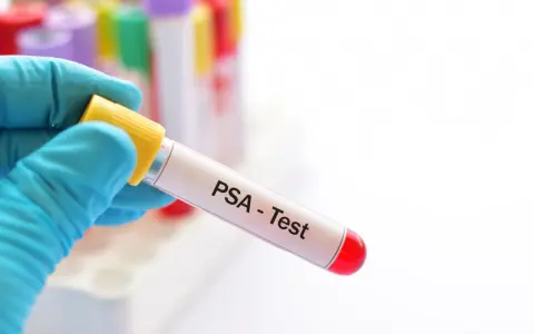 Ręka w niebieskiej rękawiczce trzyma probówkę z napisem "PSA - Test". To kluczowy krok w diagnostyce, który może pomóc w zrozumieniu, jak obniżyć psa prostaty.