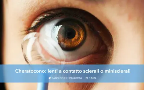 Occhio con cheratocono e lente a contatto applicata. Soluzioni per la visione con cheratocono.