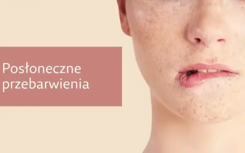 Jak poprawić koloryt cery? Widok zbliżenia na twarz z widocznymi przebarwieniami i piegami.