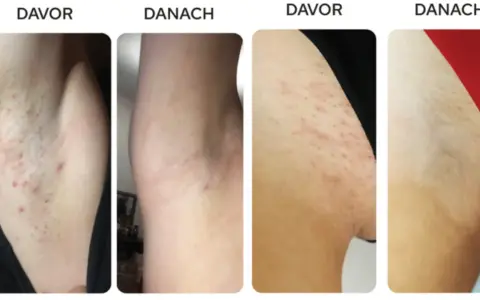 Vorher/Nachher-Bilder zeigen Achseln mit Pickeln nach dem Rasieren. Nach der Anwendung ist die Haut glatter, was zeigt, wie man rasieren ohne Pickel kann.