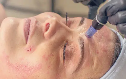 Zabieg dermapen w domu: mikroigłowanie skóry twarzy, widoczne zaczerwienienia i drobne nakłucia.