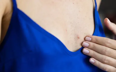 Jak pozbyć się pryszczy na dekolcie - skuteczne metody i porady