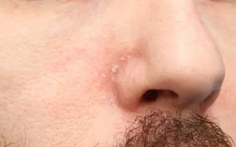 Pelle arrossata e desquamata intorno al naso, sintomo di dermatite seborroica.
