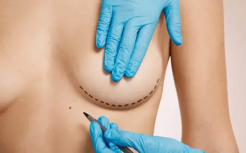 Mani guantate disegnano il contorno per una mastoplastica additiva, segnando il percorso per un futuro miglioramento.