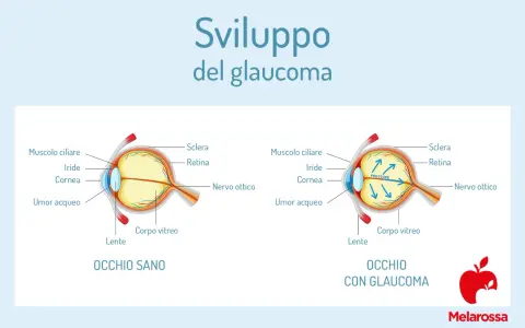 Confronto tra occhio sano e occhio con glaucoma, illustrando l'aumento di pressione. Il termine "abbigliamento significato" non si applica qui.