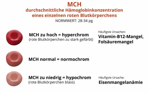 MCH-Wert: rote Blutkörperchen können hyperchrom (zu stark gefärbt), normochrom oder hypochrom (blass) sein. Ursachen für MCH-Abweichungen sind u.a. Vitaminmangel oder Eisenmangelanämie.