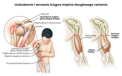 Ilustracja pokazuje uszkodzenie i zerwanie ścięgna bicepsa, powodujące ból bicepsa i objaw Popeya.