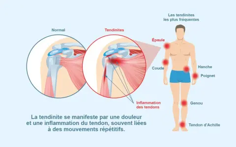 Illustration montrant une tendinite à l'épaule, une inflammation des tendons. L'ibuprofène peut aider à soulager ces douleurs.