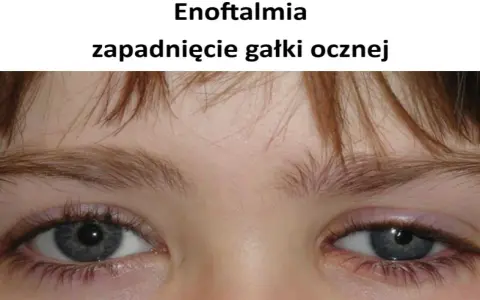 Widoczne zapadnięte oczodoły, objaw enoftalmii.