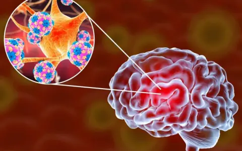 Illustration av hjärnan med en förstorad vy av virus som orsakar hjärnhinneinflammation.