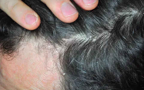 Dedos separando cabello oscuro con caspa blanca. ¿Cómo aliviar el picor de cabeza por estrés?
