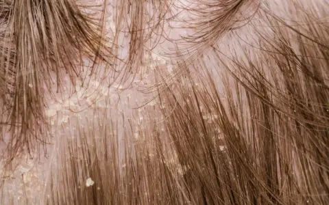 Nahaufnahme der Kopfhaut mit sichtbaren gelblichen Krusten und Schuppen, die sich zwischen den braunen Haaren abzeichnen.