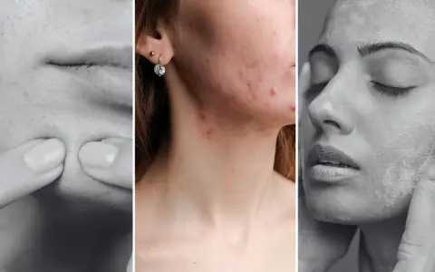 Trzy panele pokazujące problemy skórne: wyciskanie pryszcza, trądzik na twarzy i szyi, oraz pielęgnacja skóry. Dermatologia i wenerologia w praktyce.