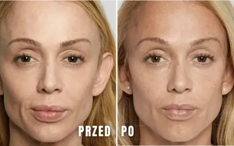 Przed i po zabiegu Sculptra. Zmarszczki wokół ust i oczu są mniej widoczne. Brak informacji o skutkach ubocznych.