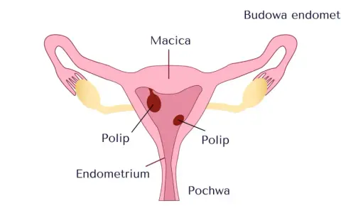 Schemat budowy macicy z widocznymi polipami. Endometrium jest cienkie, co może utrudniać implantację.