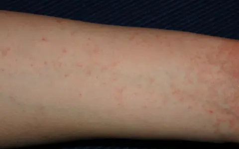 Braccio con piccoli puntini rossi, un segno di inizio scabbia. La pelle appare leggermente irritata.