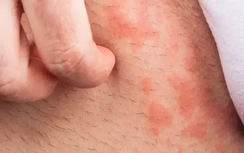 Haut mit roten Flecken und Haaren, die von einem Finger gekratzt werden. Backpulver gegen Juckreiz könnte Linderung verschaffen.