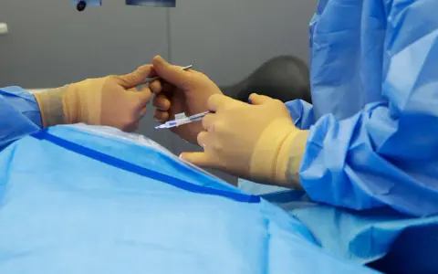 Mani guantate eseguono un intervento chirurgico oculare, forse un piombaggio retina, con precisione.