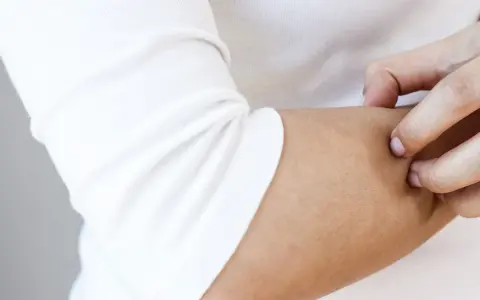Dłoń drapiąca ramię, szukająca ulgi od swędzenia skóry.