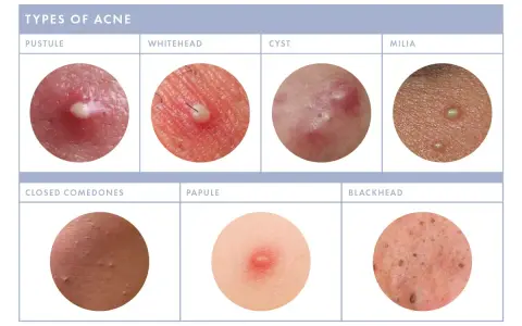 Close-up images show various types of acne, including pustules, whiteheads, cysts, milia, closed comedones, papules, and blackheads. Some show small white bumps on the face.