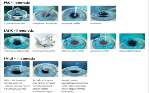 Ilustracje pokazują metody korekcji wzroku laserem: PRK, LASIK, SMILE. Nie ma tu informacji o laserze na kręgosłup lędźwiowy przeciwwskazania.