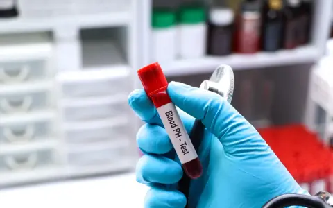Ręka w niebieskiej rękawiczce trzyma probówkę z krwią do badania pH. Gazometria jest kluczowa w diagnostyce niewydolności nerek.