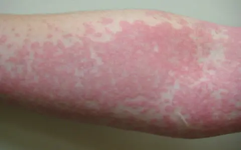 Brazo con extensas ronchas rojas en la piel, indicando una posible reacción alérgica o irritación cutánea.