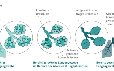 Veranschaulicht die Zerstörung von Lungenbläschen bei COPD, auch ohne Rauchen. Zeigt gesunde, erweiterte und geplatzte Lungenbläschen.