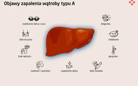Objawy zapalenia wątroby typu A: zażółcenie skóry, bóle brzucha, brak apetytu, nudności, biegunka, osłabienie, gorączka, bóle stawów, swędzenie skóry.
