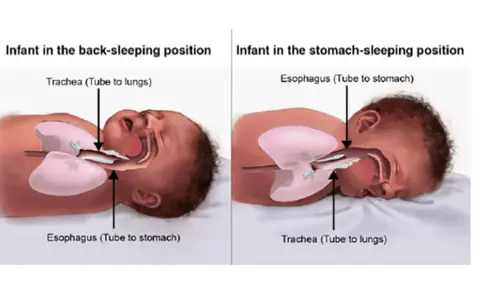 Illustrazione anatomica che mostra come far addormentare un neonato in posizione supina, con trachea e esofago liberi.