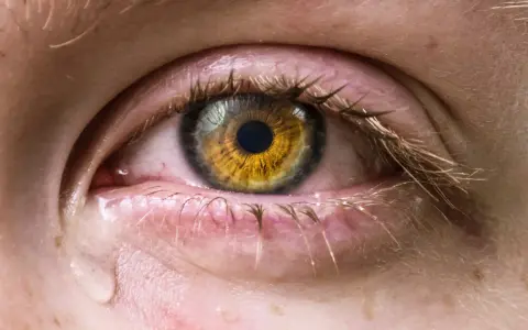 Occhio con iride dorata, palpebre arrossate e lacrime che scendono, sintomo di occhio secco grave.